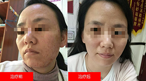 南京华肤皮肤病医院:你的痤疮是这样的吗?